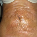 2 days post procedure